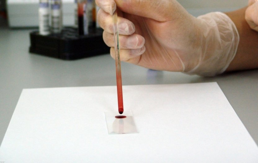 В Британии женщина заболела раком почки и легких после отказа от курения